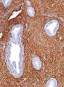 Endometrial stroma - cd10 - intermed mag.jpg