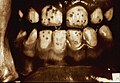 Dental fluorosis from the National Library of Medicine