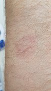 Dermatophytosis 20191130-02ASD.jpg