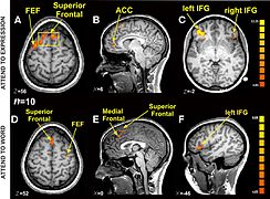 FMRI BOLD activation in an emotional Stroop task.jpg