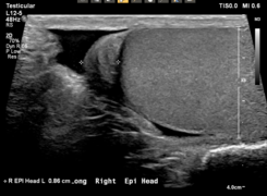 Epididymal head, with measurement, longitudinal view.png