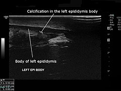 Ultrasound sagittal section showing calcification in the left epididymis body.jpg