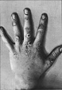 An introduction to dermatology (1905) ERYTHEMA IRIS.jpg