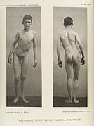 A young man with body deformed through sciatica Wellcome L0034941.jpg