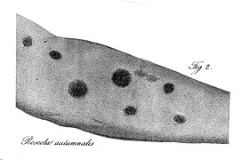 R. Willan; Roseola autumnalis, 1808 Wellcome L0001956.jpg