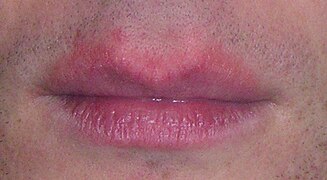 Erythema around the lips (unlabeled).jpg