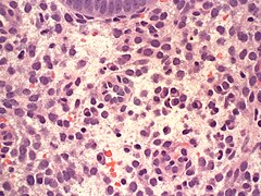 Endometrium PlasmaCells 20x1.JPG