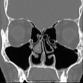 Front cross CT sections of nasal cavities, after a partial (about 80%) and bilateral inferior turbinectomy