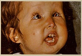 Hallerman-Streiff Syndrome 4.jpg