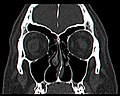 Front cross CT sections of nasal cavities after a total inferior turbinectomy