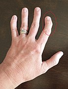 Osteoarthritis in the left hand index finger.jpg