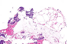 Endometrium and adipose tissue - alt -- intermed mag.jpg