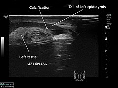 Ultrasound sagittal section showing small calcification of left epididymis.jpg