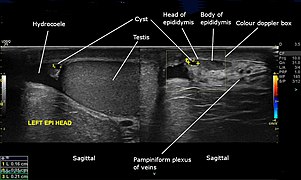 Ultrasound showing head of left epididymis cyst with hydrocoele.jpg