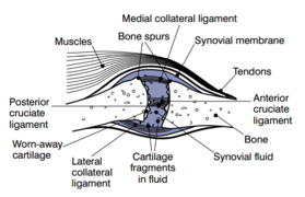 Joint with severe osteoathritis.png