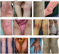 Clinical features of atopic dermatitis in English.png