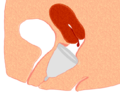 Correct menstrual cup insertion