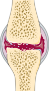 Rheumatology - Osteoarthritis 3 -- Smart-Servier.png