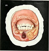 Diseases of the mouth; for physicians, dentists, medical and dental students (1912) (14772644622).jpg