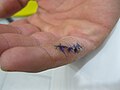 en:Nonabsorbablesuture