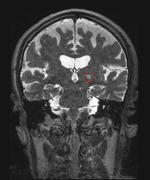 MRI-guided HIFU, essential tremor, 10-14 135, pointed.png