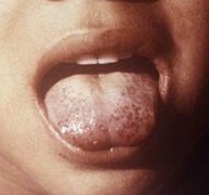 Scorbutic tongue (cropped).jpg