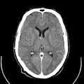 Brain, case 2: contrast CT, axial plane only