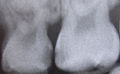 Interpoximal decay in deciduous teeth.