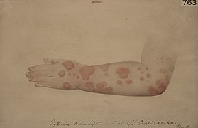 Erythema circumscriptum of an arm Wellcome L0061875.jpg