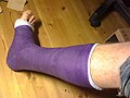 osmwiki:File:Short leg cast.jpg