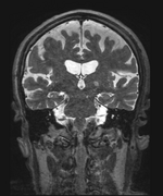 MRI-guided HIFU, essential tremor, 10-14 135.png