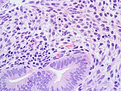 Endometrium SinglePlasmaCell 20x1.JPG