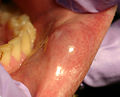 A mucocele on the lower lip