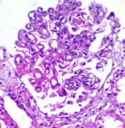 Wire-loop lesion in SLE.png