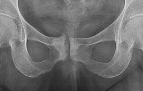 X-rays of pubic symphysis osteoarthritis.jpg