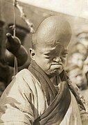 Chinese circus performer with craniosynostosis, 1927.jpg