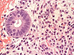 Endometrium PlasmaCells 20x2 copy.JPG