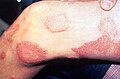 Cutaneous lesions of leprosy in thigh