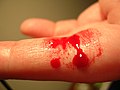 Bleeding finger