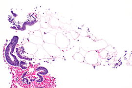 Endometrium and adipose tissue -- intermed mag.jpg