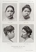 A woman with a deformed and swollen face Wellcome L0034946.jpg