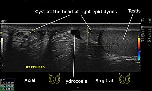 USG showing cyst at the head of right epididymis.jpg