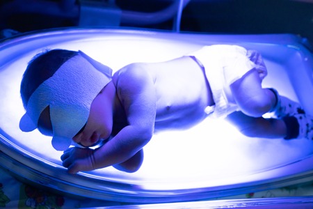 The baby lies under an ultraviolet lamp with jaundice Фото со стока