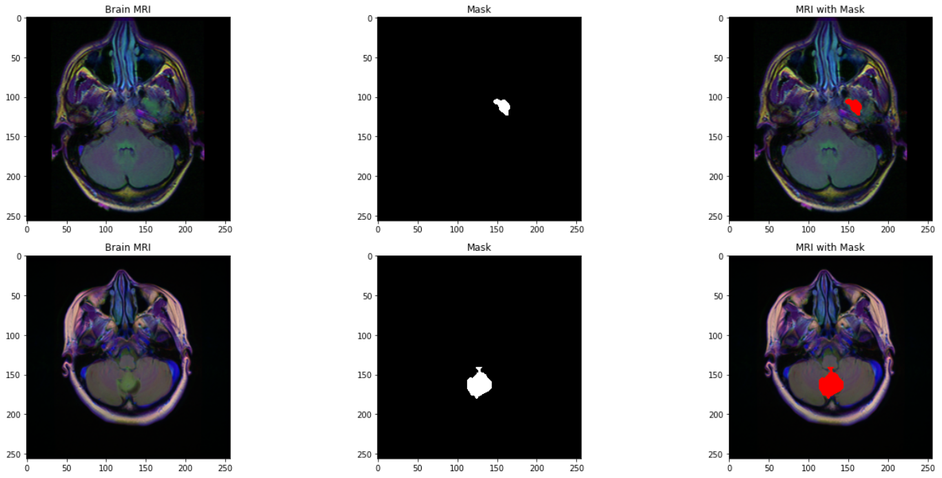 MRI mask and overlap