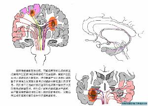 癲癇