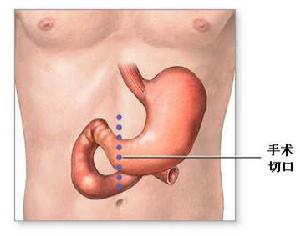 胃出血手術切口
