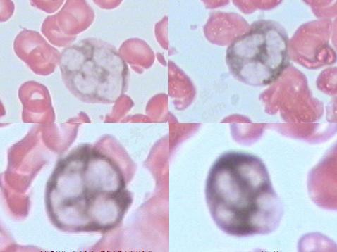 中性粒細胞鹼性磷酸酶染色