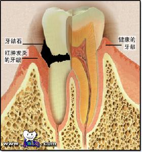 牙齦炎
