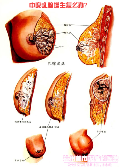 乳腺增生