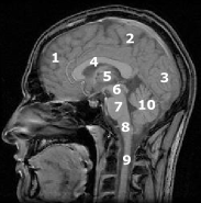 MRI of brain